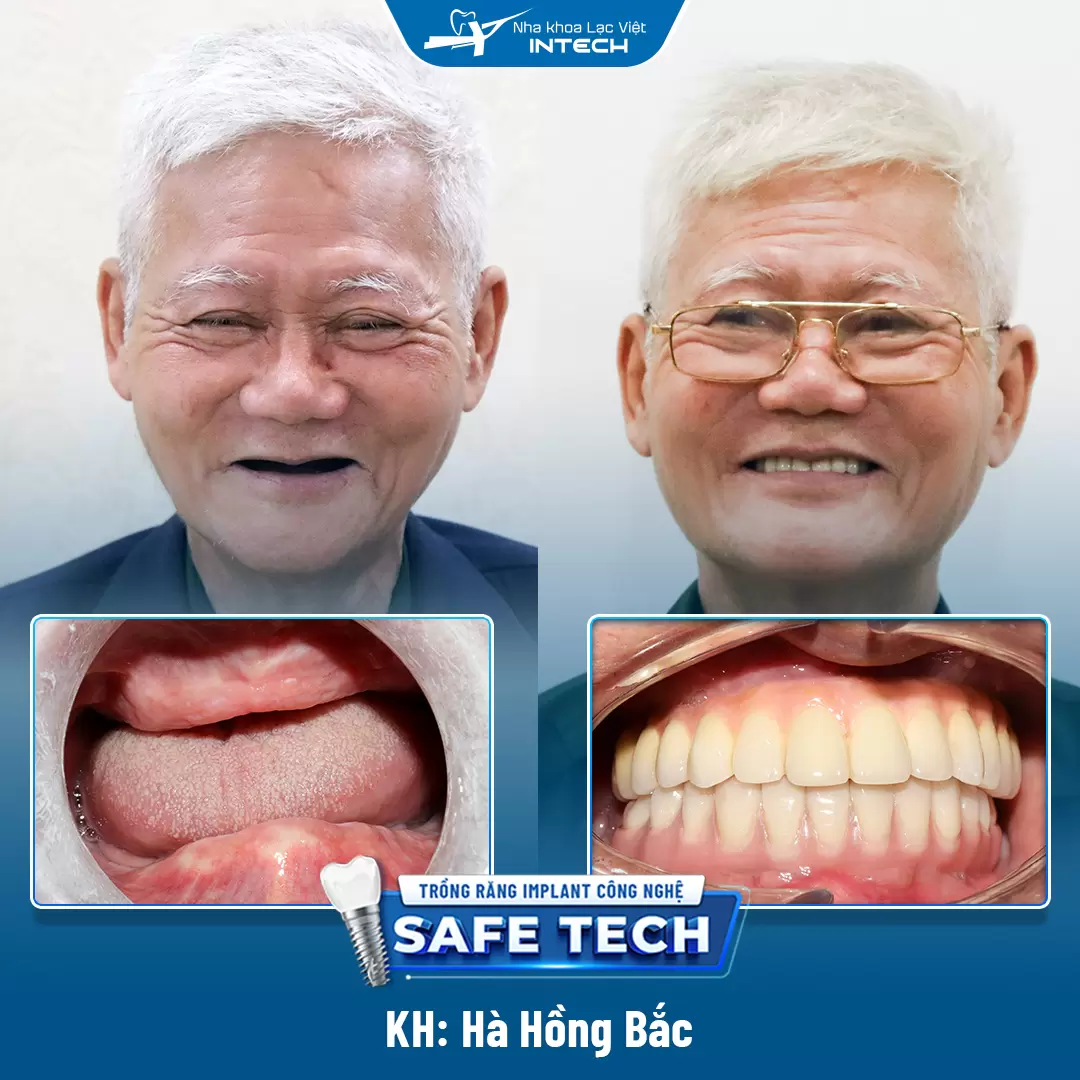 case trồng răng bác sĩ hoàng vũ hiệp