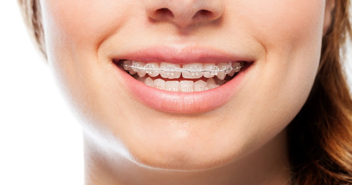 kinh nghiệm niềng răng mắc cài sứ