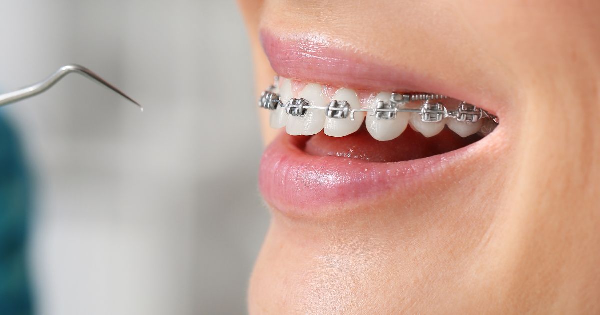 Quy Trình Niềng Răng Mắc Cài