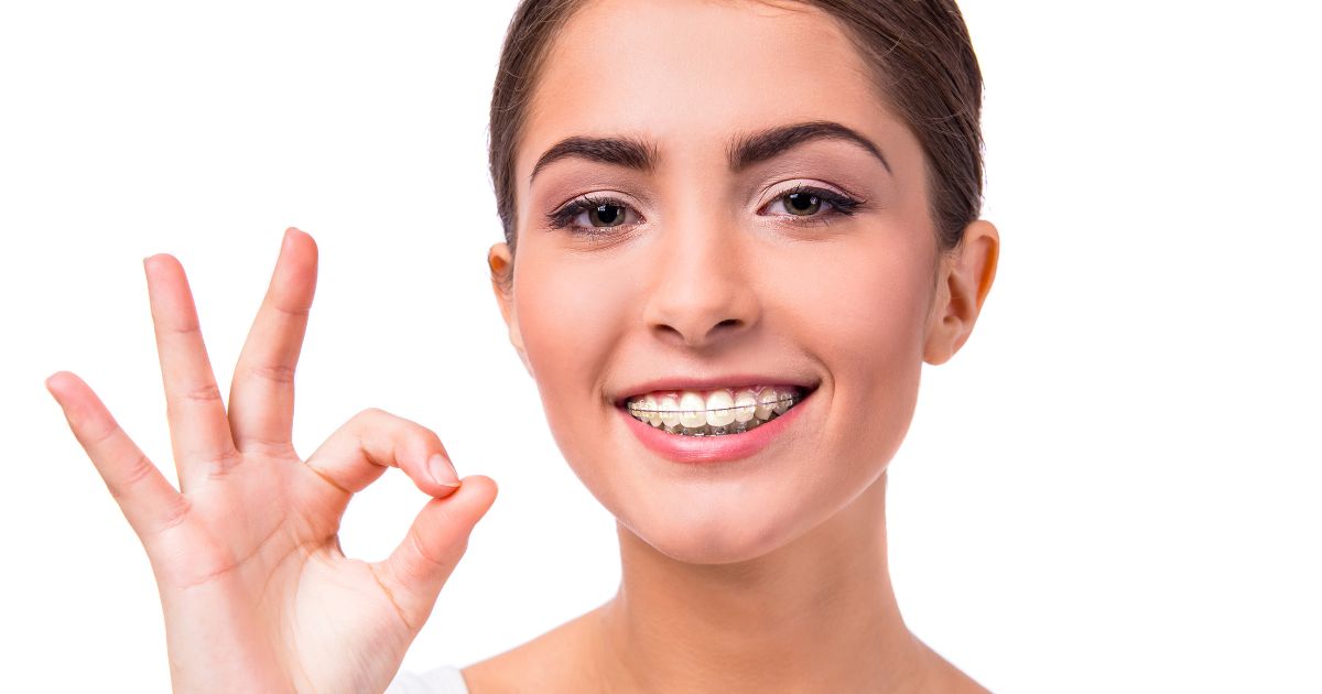 kinh nghiệm niềng răng mắc cài sứ