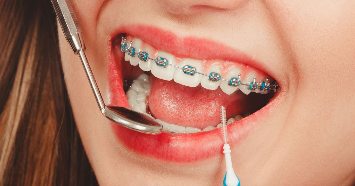 Niềng Răng Mắc Cài Kim Loại Tự Buộc