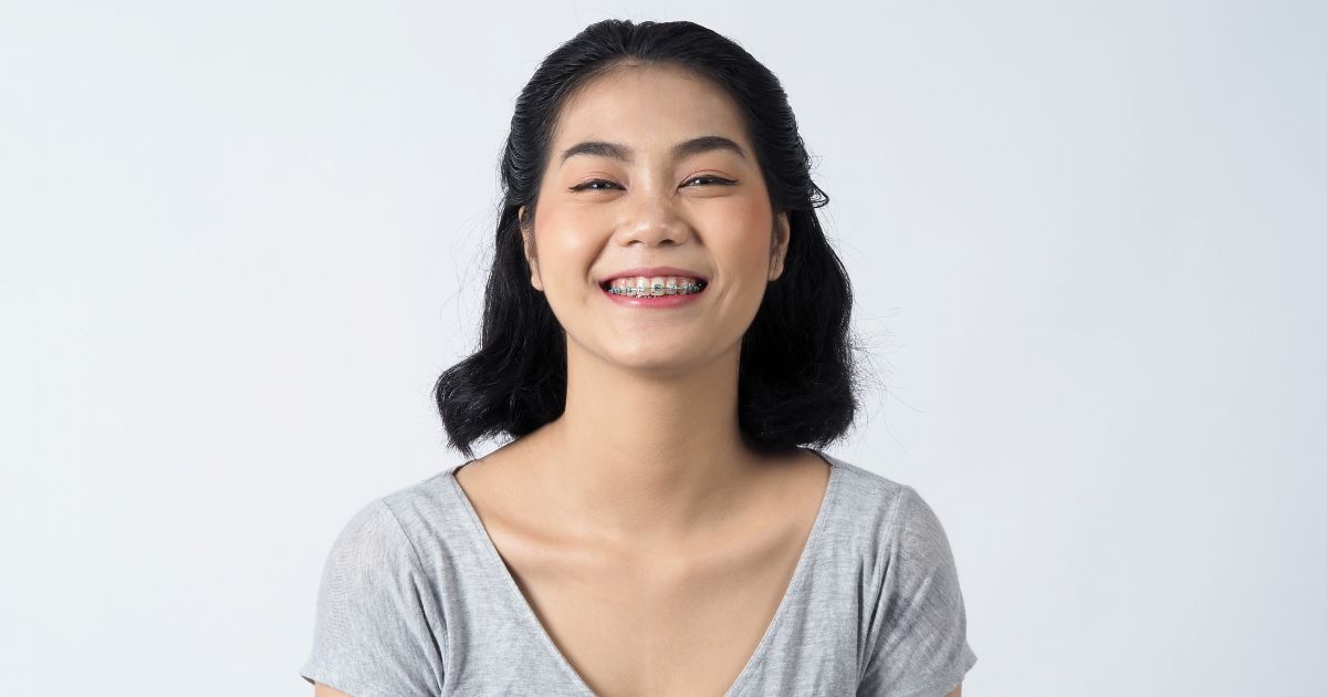 Niềng Răng Mắc Cài Kim Loại Tự Buộc