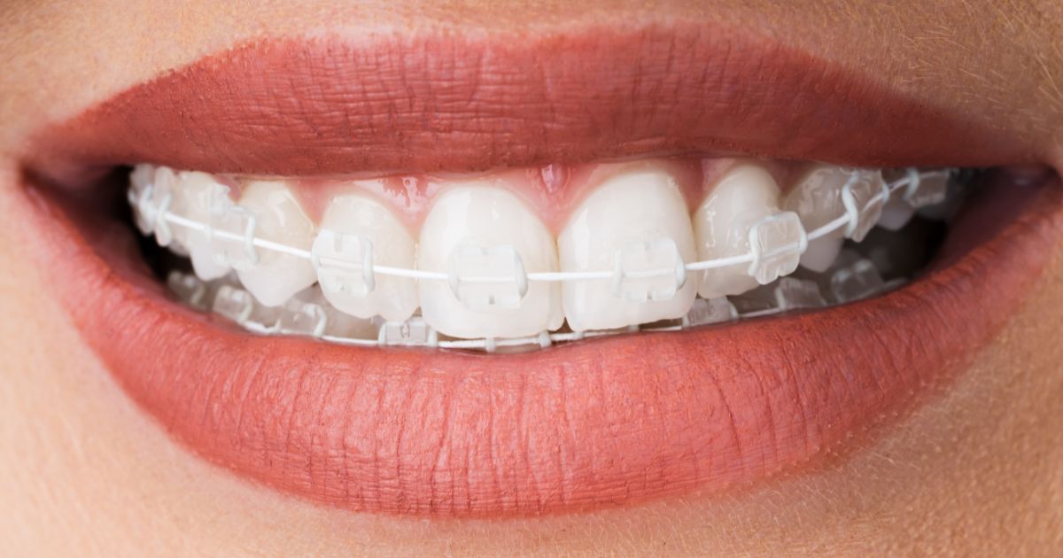 Niềng Răng Mắc Cài Sứ Dây Trong