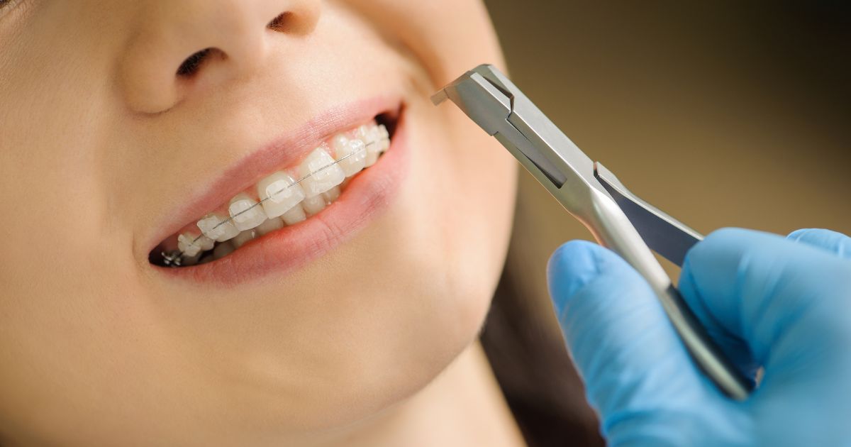 Niềng Răng Mắc Cài Sứ Dây Trong