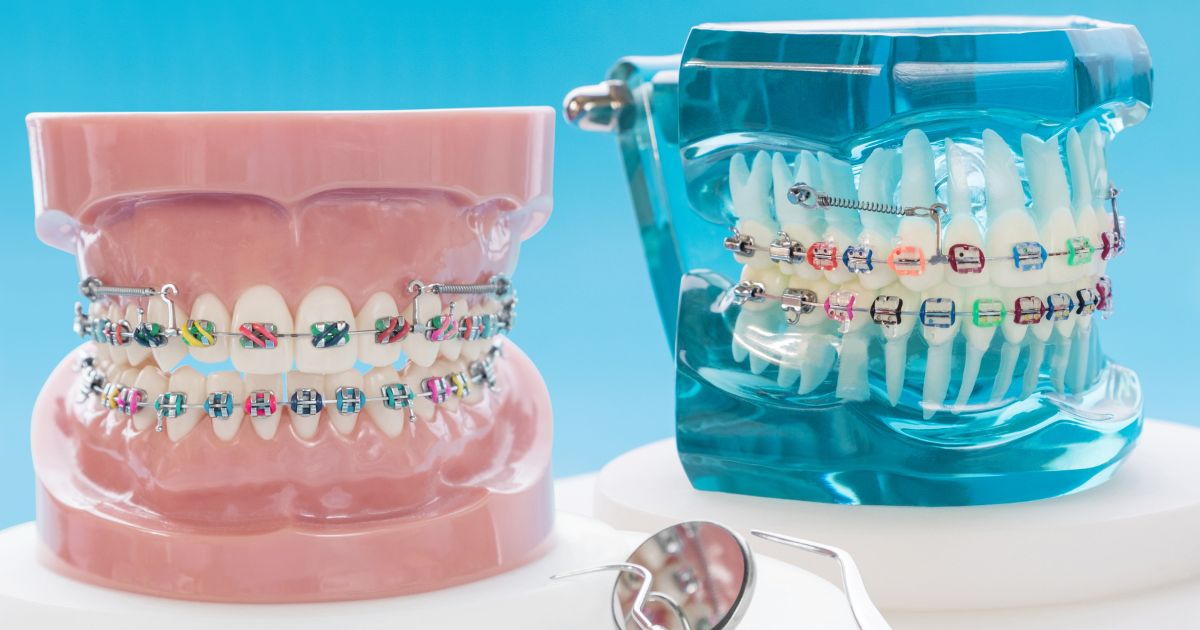 Niềng Răng Mắc Cài Kim Loại Tự Buộc