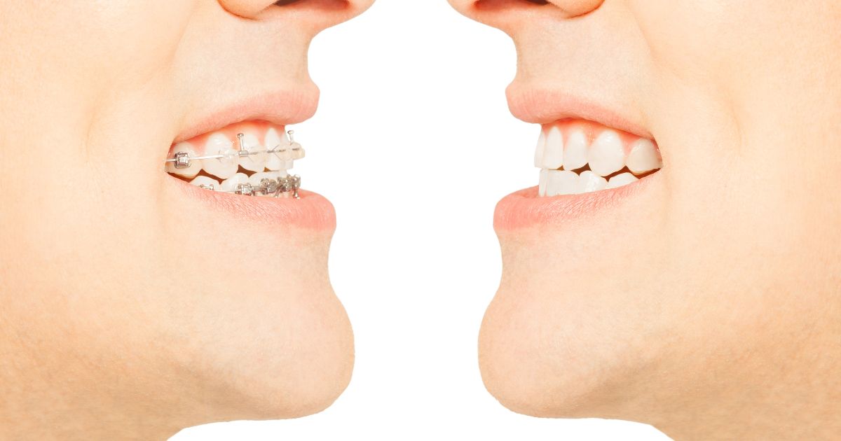 Niềng Răng Mắc Cài Sứ Dây Trong