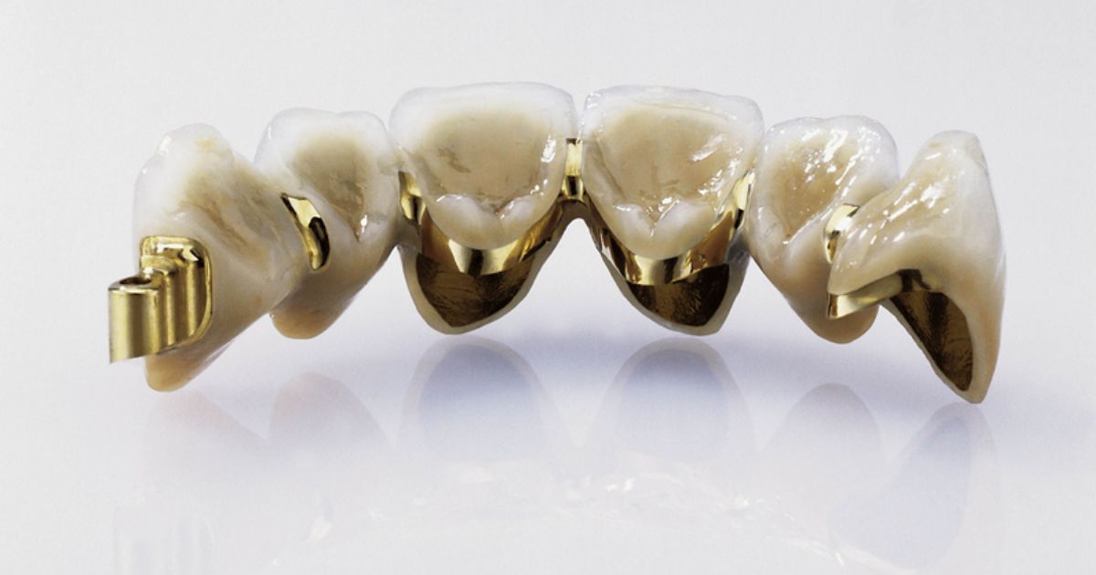 tác hại của răng sứ kim loại