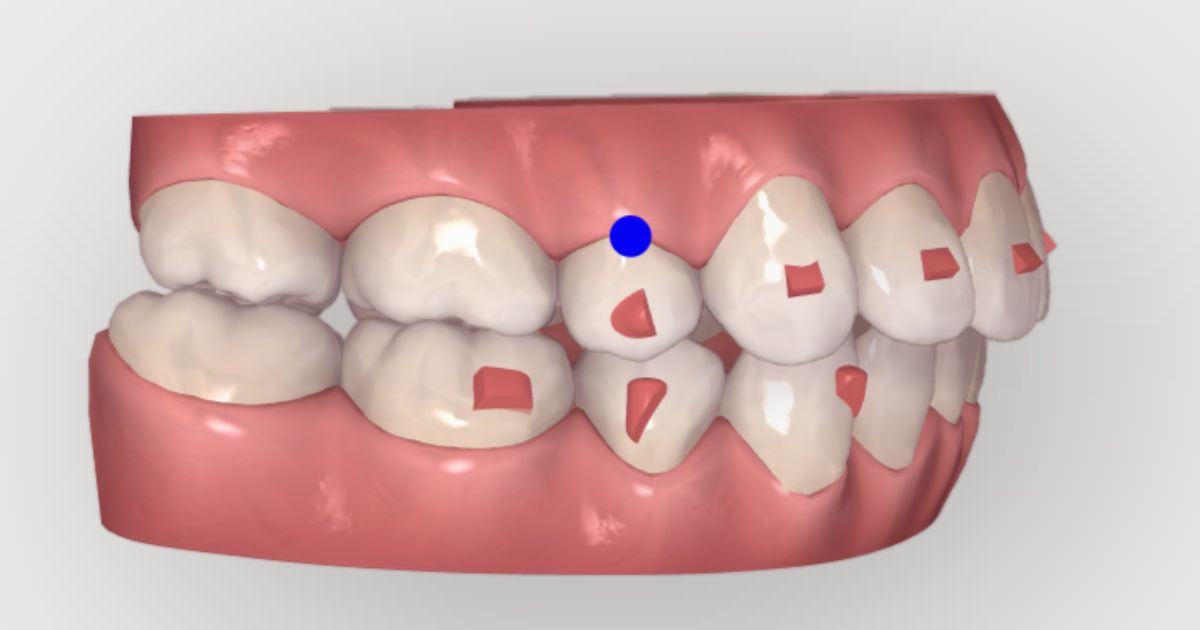 Gắn Attachment Khi Niềng Invisalign
