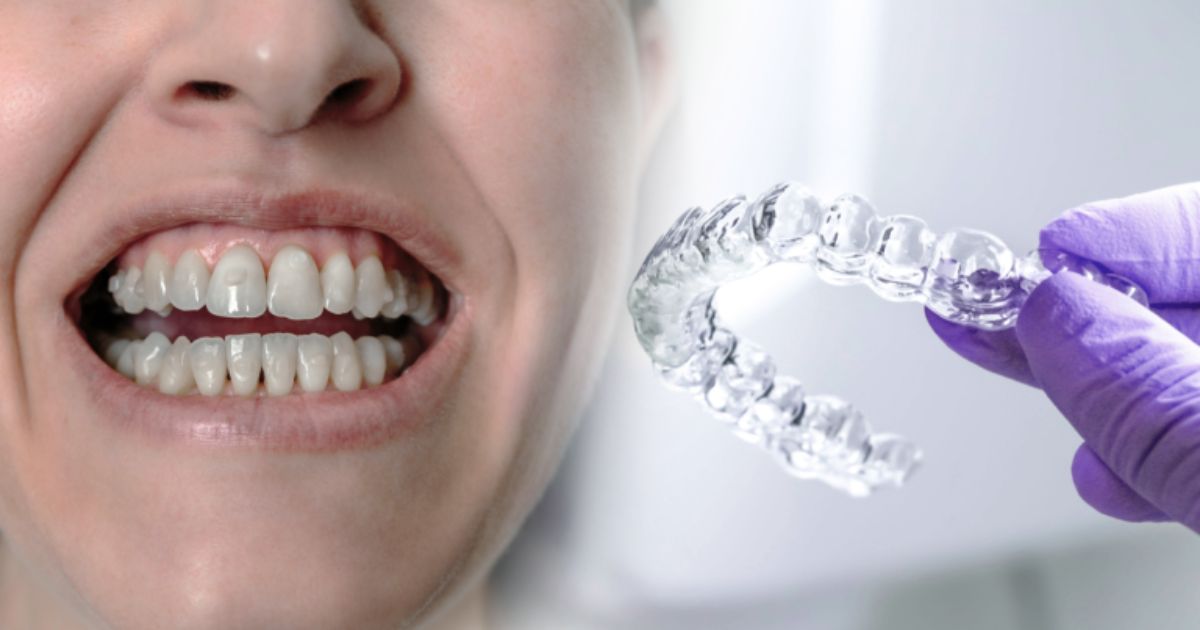 Gắn Attachment Khi Niềng Invisalign