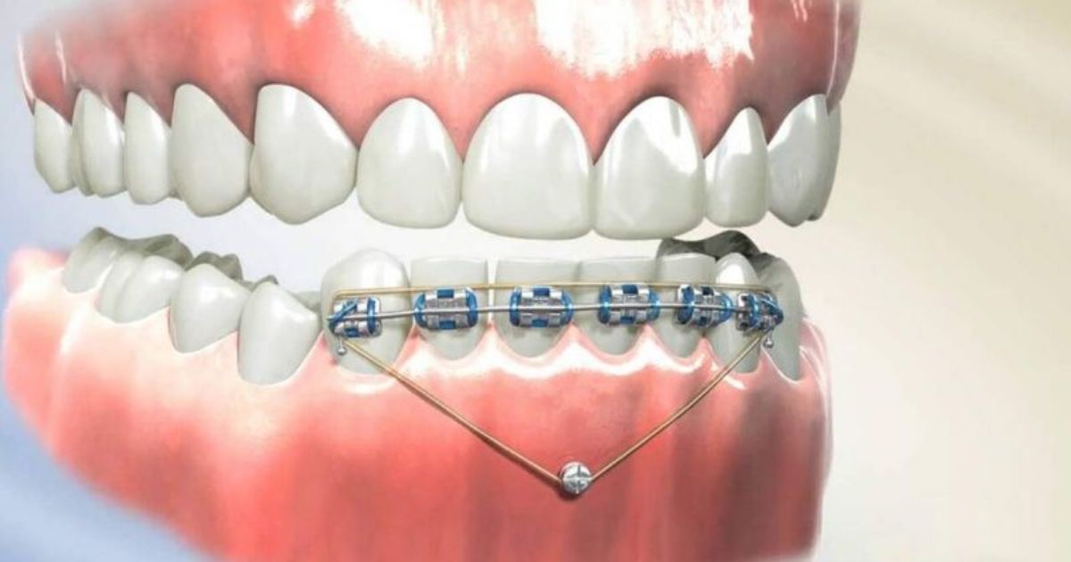 Khi Nào Cần Cắm Vis Niềng Răng