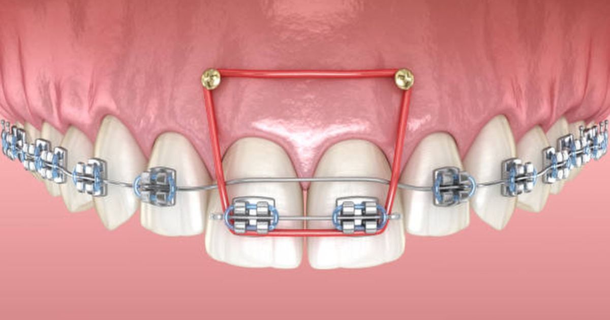 Khi Nào Cần Cắm Vis Niềng Răng