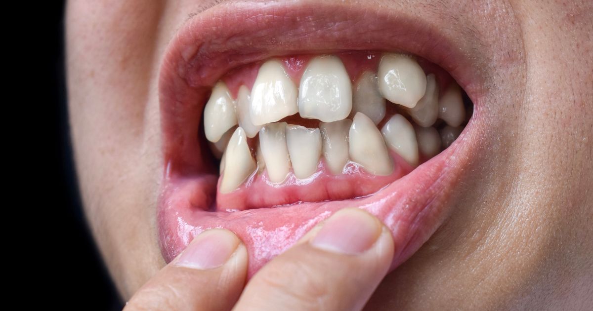Khi Nào Cần Cắm Vis Niềng Răng