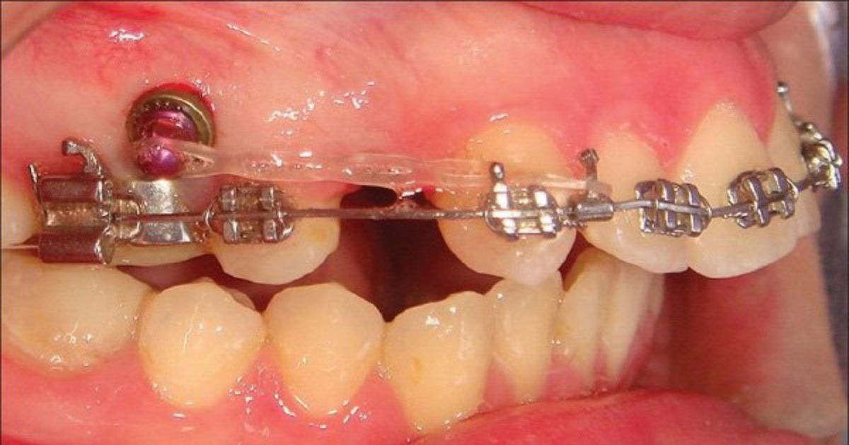 Khi Nào Cần Cắm Vis Niềng Răng