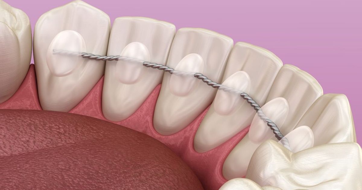 nieng-rang-invisalign-co-can-deo-ham-duy-tri-khong