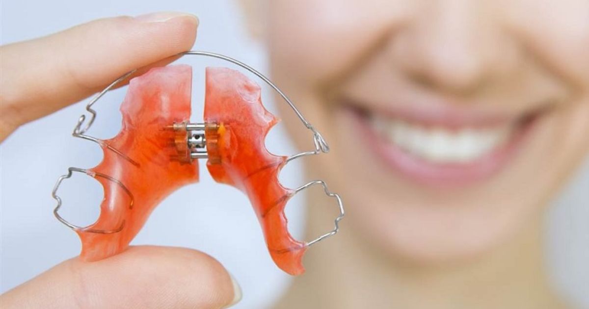 nieng-rang-invisalign-co-can-deo-ham-duy-tri-khong
