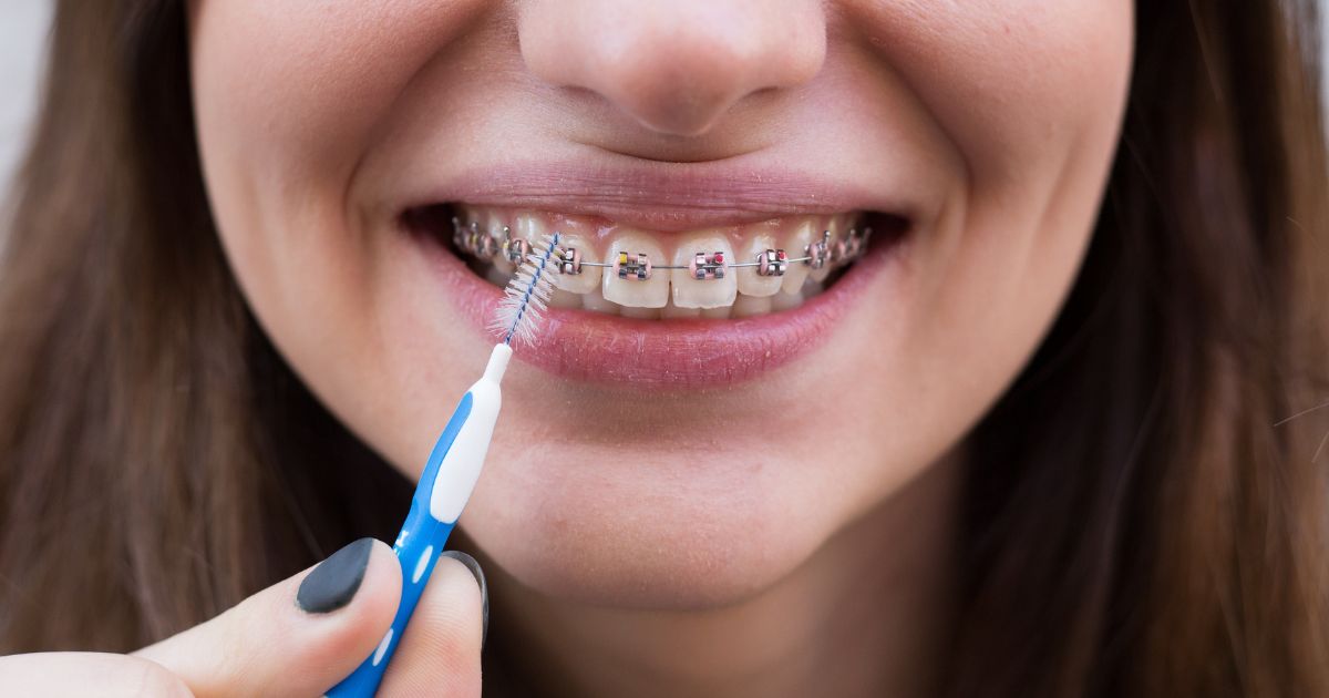 su-khac-biet-giua-cham-soc-khi-nieng-rang-mac-cai-va-nieng-invisalign