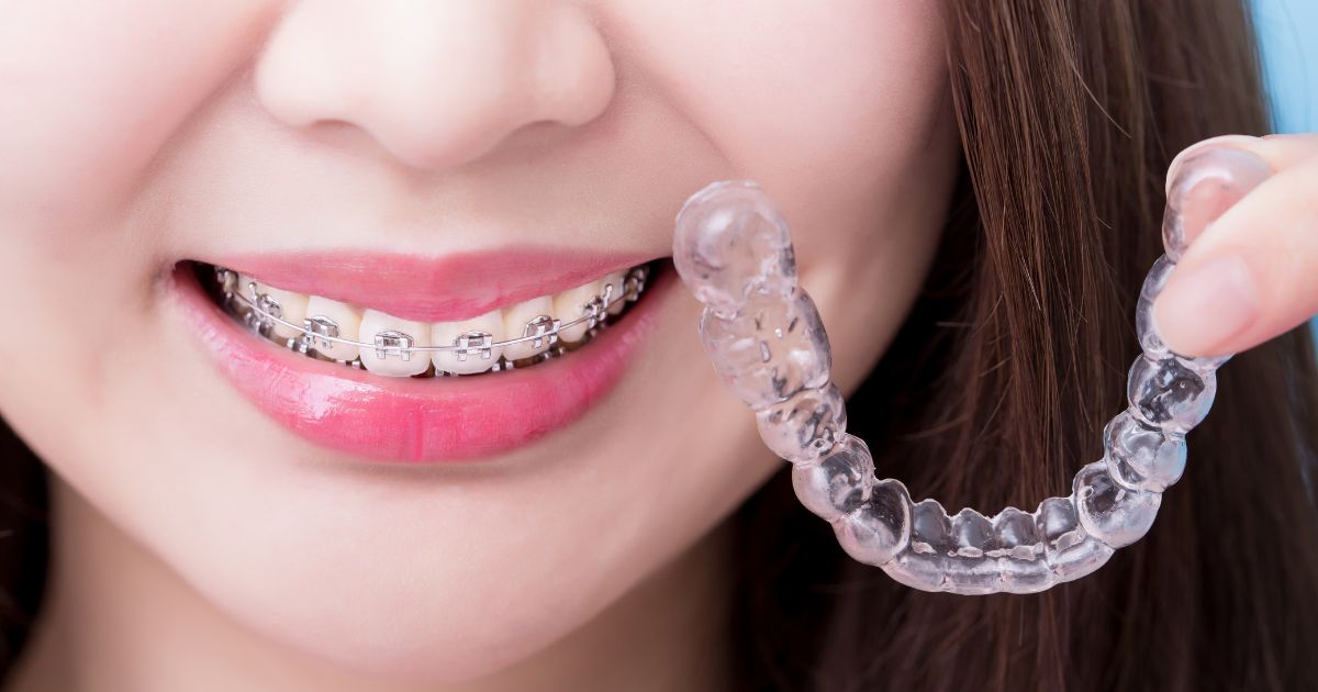 su-khac-biet-giua-cham-soc-khi-nieng-rang-mac-cai-va-nieng-invisalign