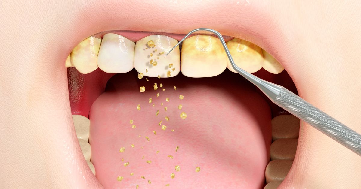 trong-rang-implant-cho-nguoi-bi-viem-nha-chu